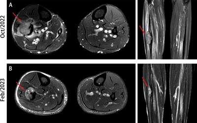 Case Report: Tumor-to-tumor metastasis with prostate cancer metastatic to lung cancer: the first reported case